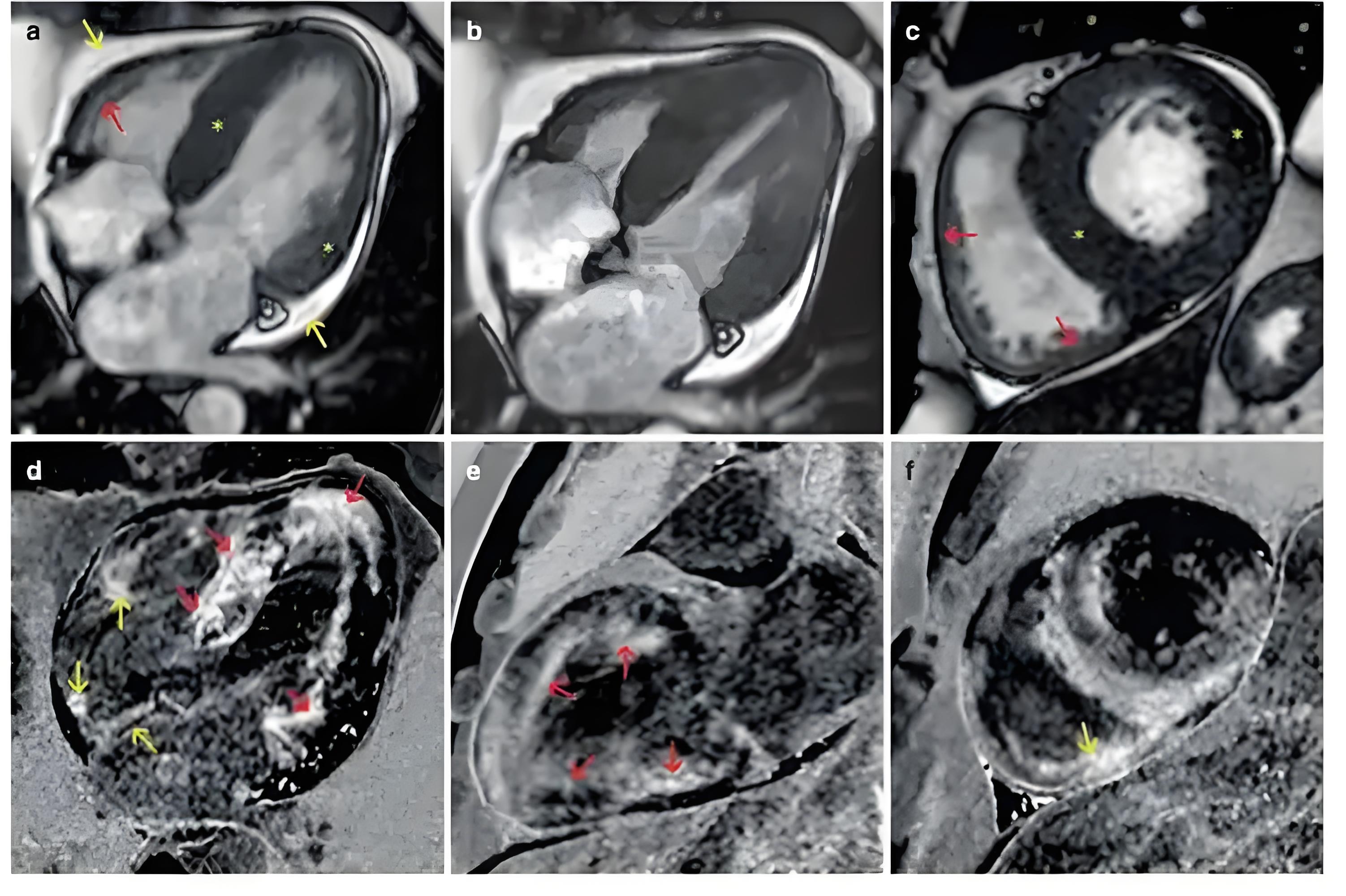心脏磁共振（cardiovascular magnetic resonance, CMR）通过多参数、多平面、多序列成像可同时对心脏解剖结构、运动功能、组织特性等进行“一站式”评估，在心肌病病因诊断、治疗及预后诊断上具有独特价值，己成为心肌病最理想无创检查手段。